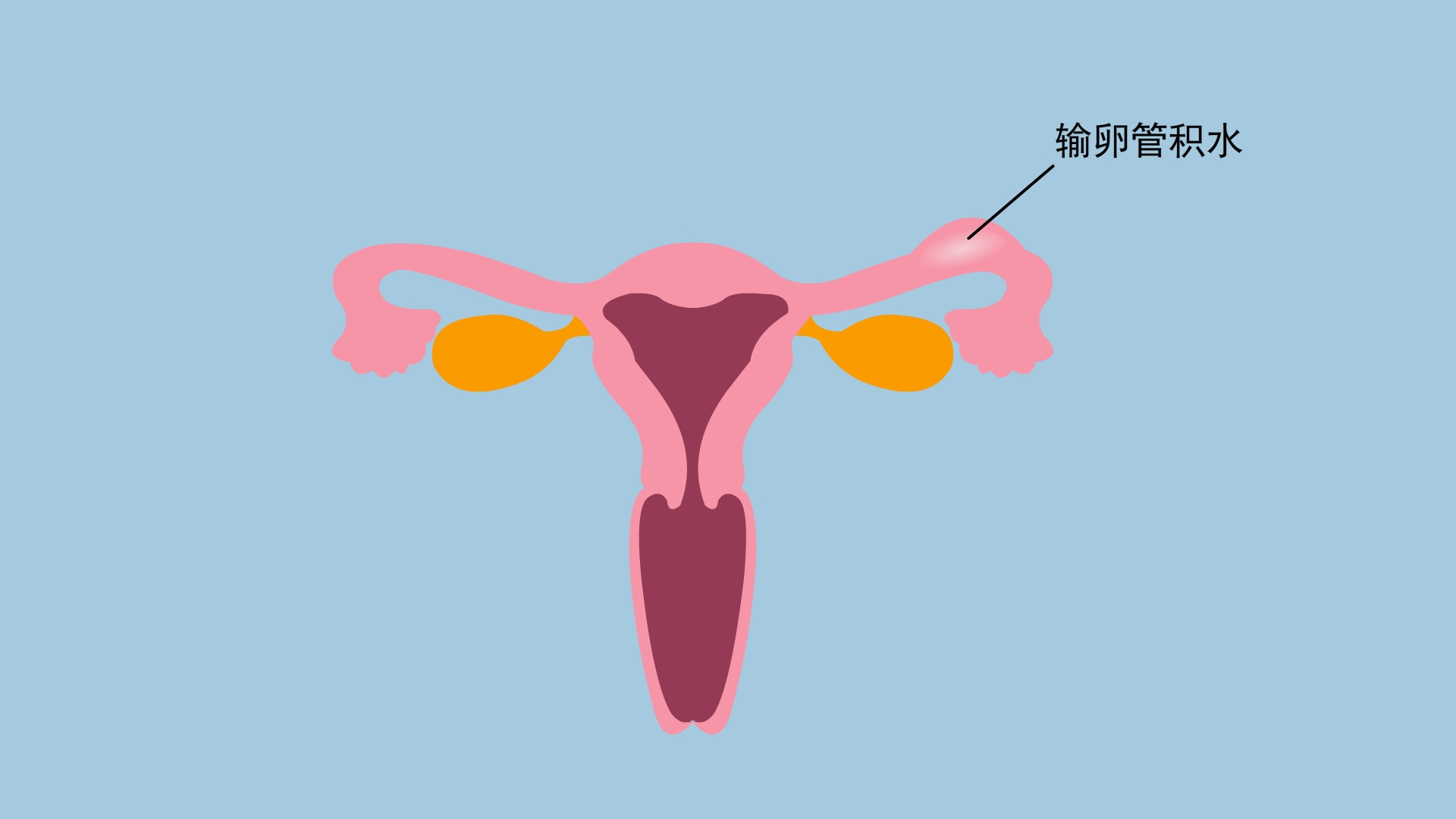 有输卵管积水能自然怀孕吗？输卵管积水要怎么办才好?