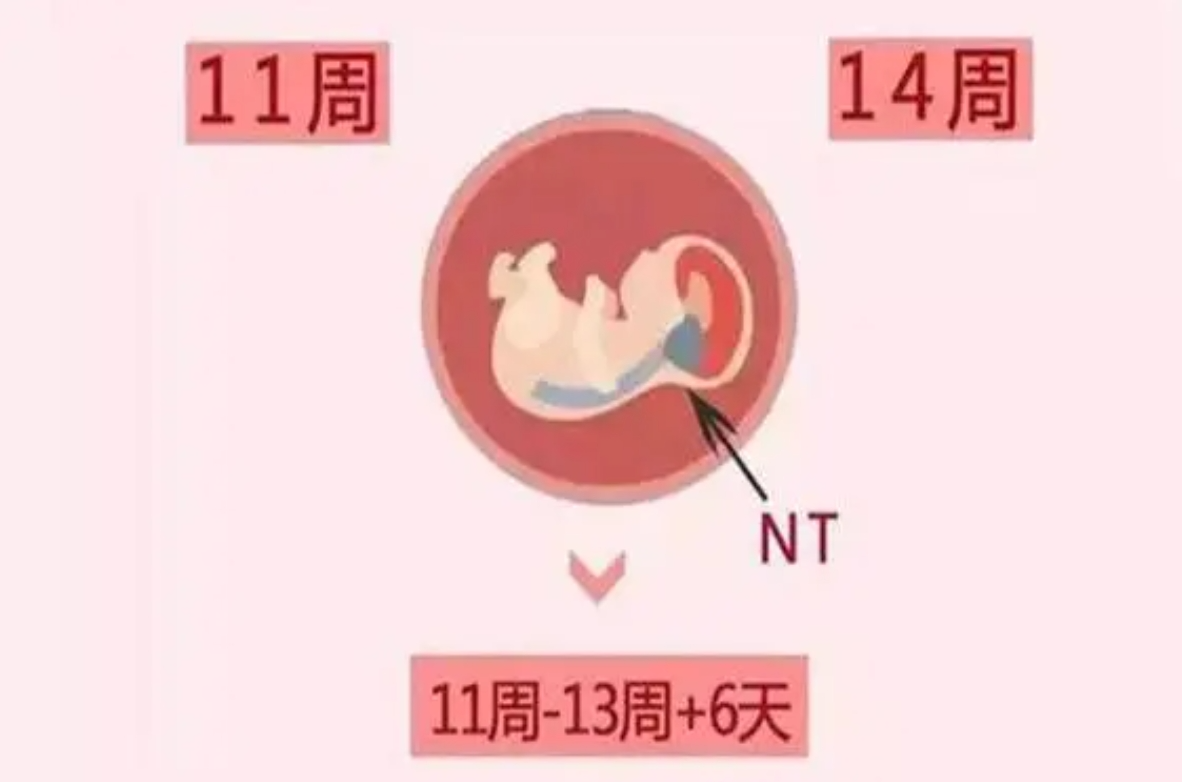 nt 值：胎儿健康的重要指标