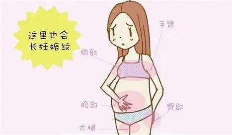 孕妇的妊娠纹是可以预防的吗 哪种孕妇不长妊娠线.jpg