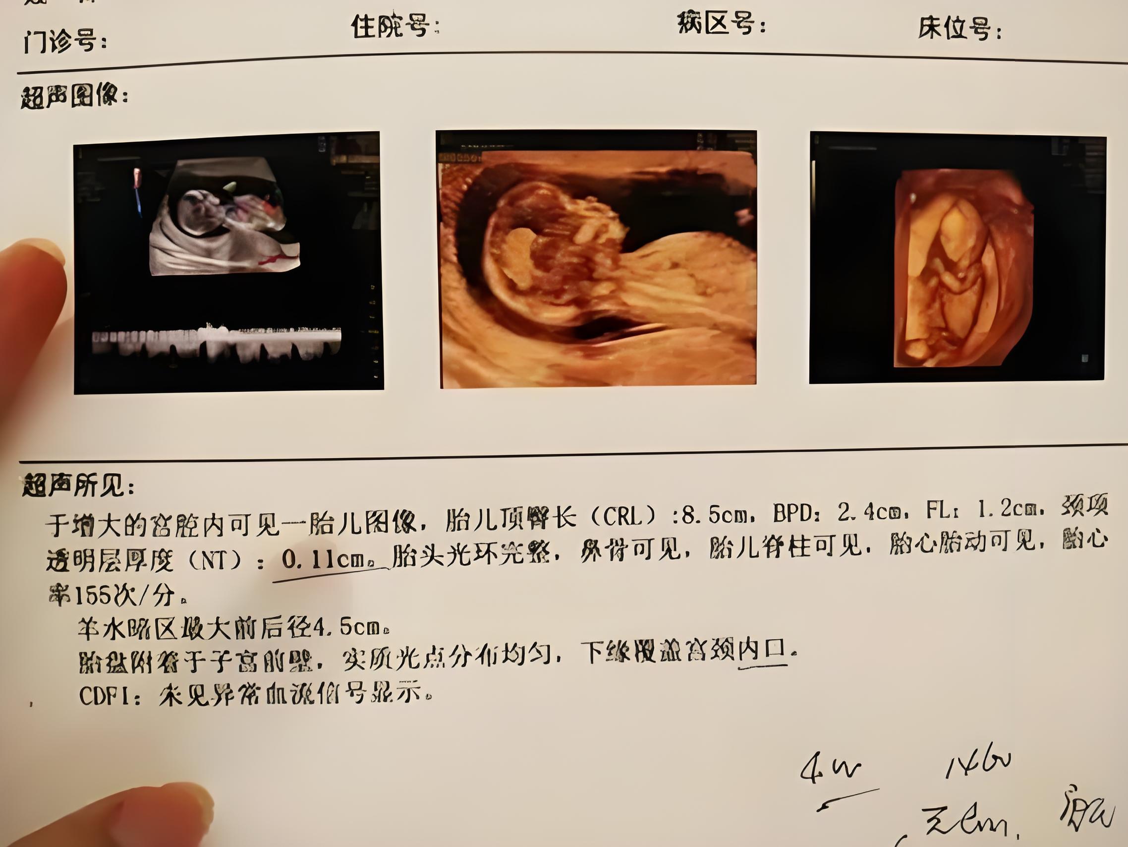 NT值1.3mm与胎儿性别预测：科学解析与性别概率探讨